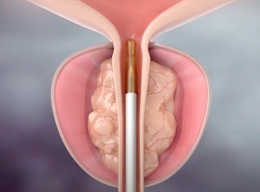Láser para la Hiperplasia Prostática